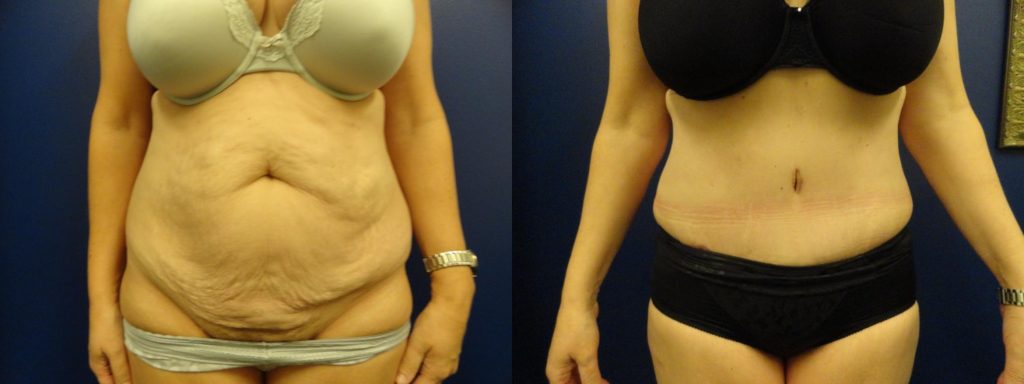 Sleek & Strong: The Surprise Benefits of a Tummy Tuck - Armijo