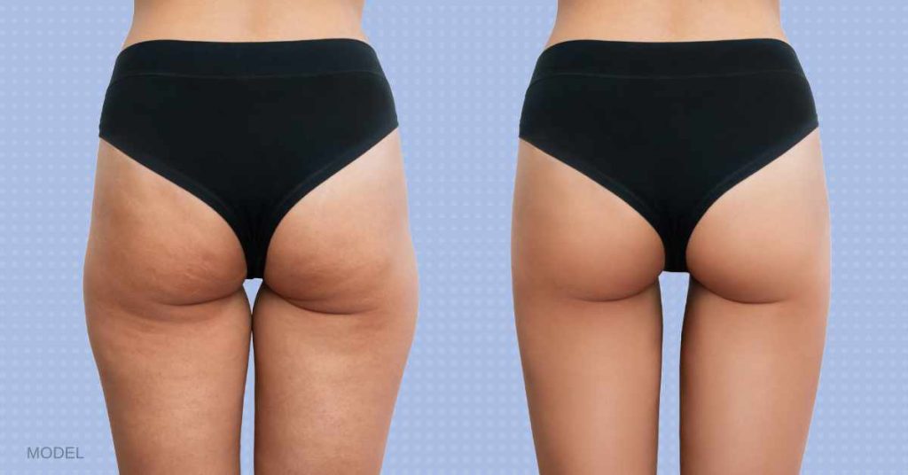 Cellulite: Scientific Proof That God Is a Man (Can New Cellulite